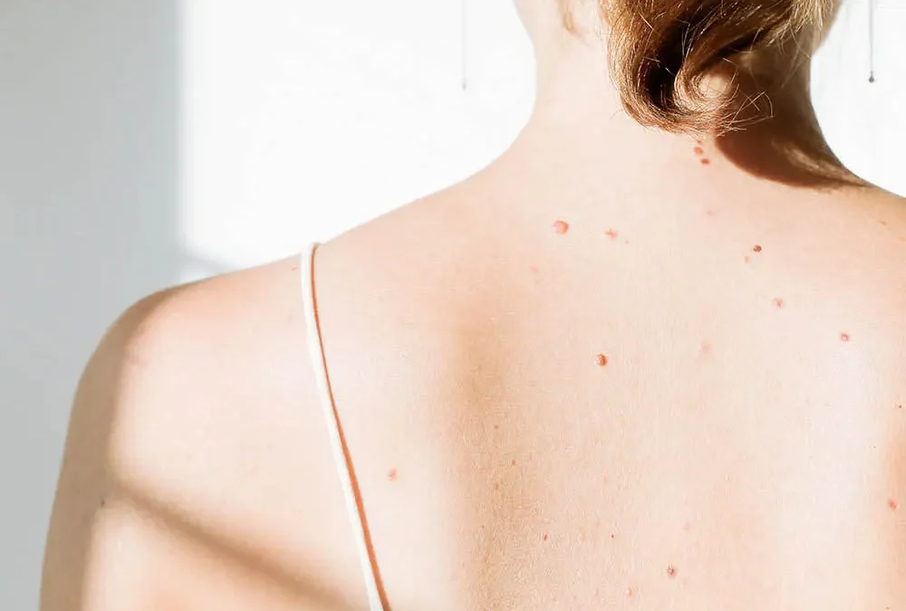 Unlocking the Benefits of Vitamin D for Perimenopause
